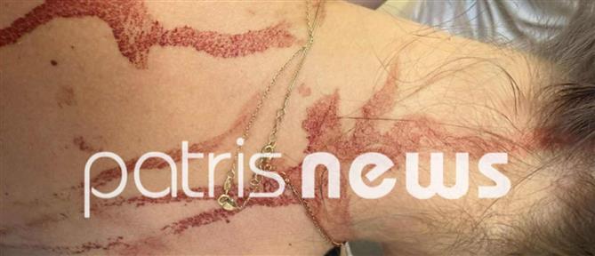 Αμαλιάδα: Προσωρινά κρατούμενη η 48χρονη που κάρφωσε γυναίκα με ψαλίδι