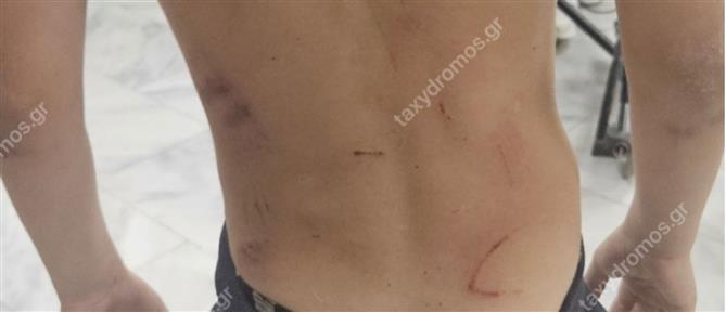 Βόλος : Αδέσποτα σκυλιά επιτέθηκαν σε 7χρονο αγόρι